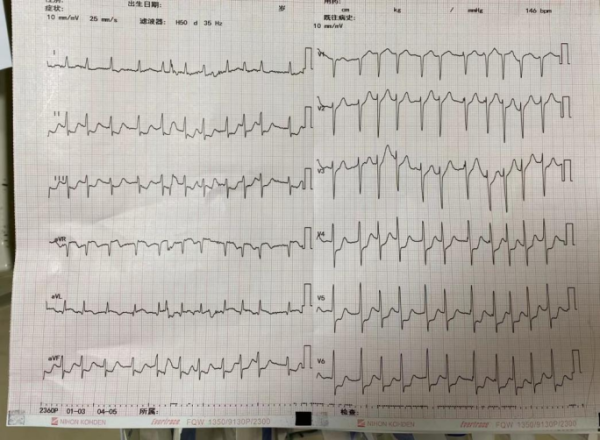 公赢网配资 发展迅速的胸痛，不要遗忘这个心血管疾病！